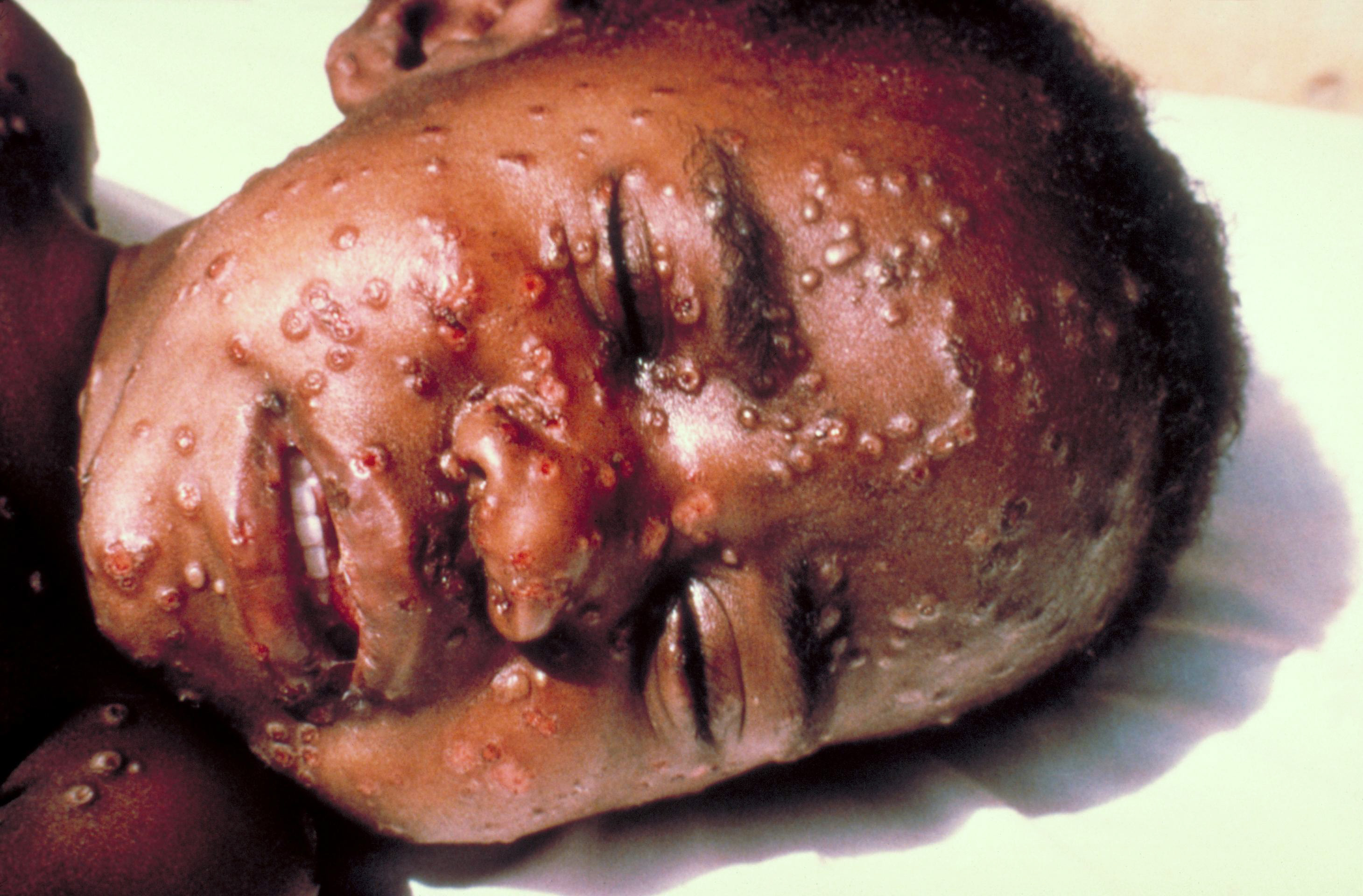 Boy with smallpox on his face